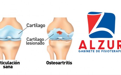 Tratamientos de fisioterapia para la artrosis de rodilla