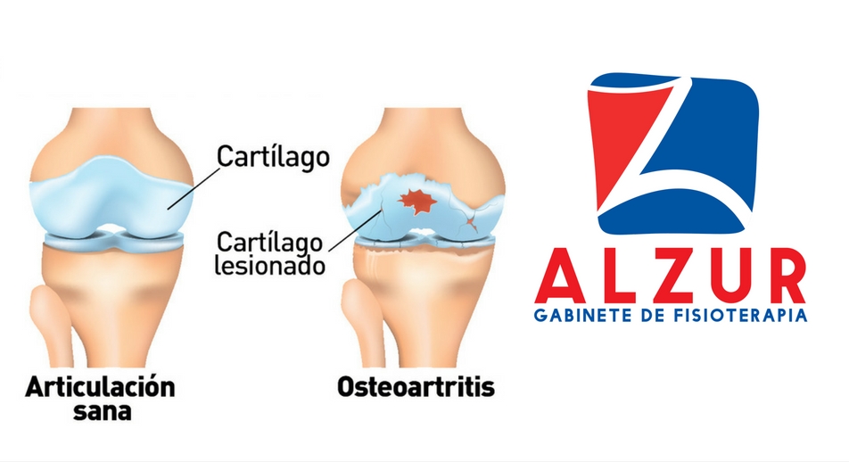 Tratamientos de fisioterapia para la artrosis de rodilla